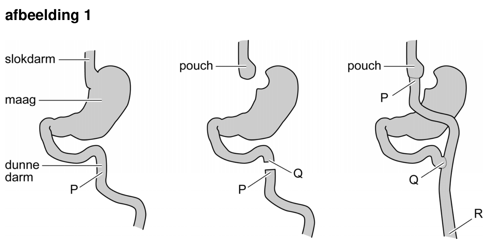 Figuur 1 bij vraag 31 van opgave Gastric bypass (Biologie HAVO 2026)